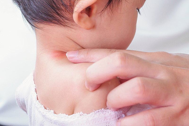 母亲在宝宝脖子上涂抗过敏霜，宝宝脖子上有皮疹，宝宝脖子上有蚊虫叮咬引起的红斑
