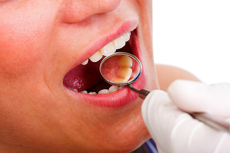 张大嘴巴的女人正在做牙科检查