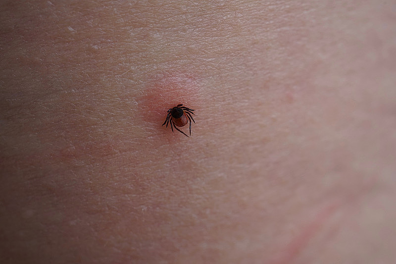 吸吮雌性蜱虫对人过敏皮肤的特写。肿胀的蓖麻硬蜱危险的寄生虫咬入粉红色的刺激表皮。脑炎和莱姆病感染的危险。
