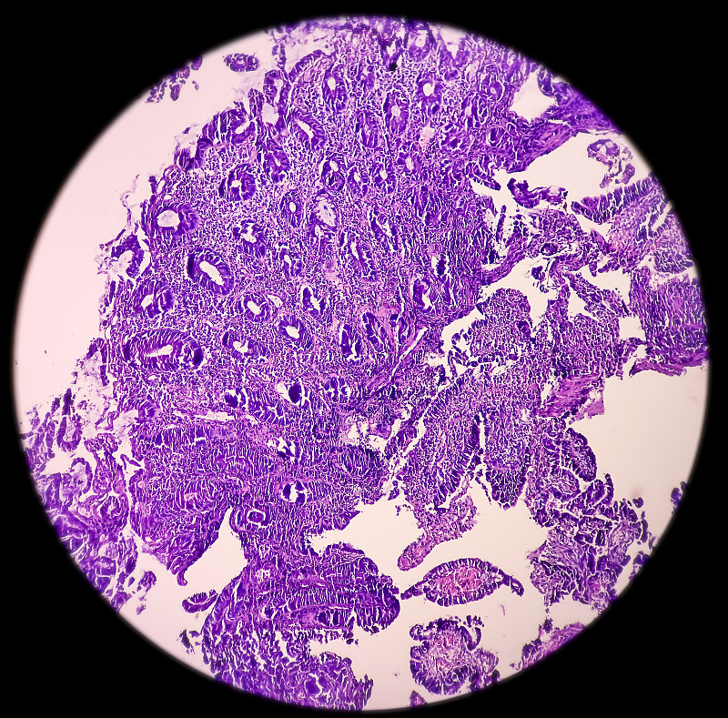 直肠腺癌镜下图片图片