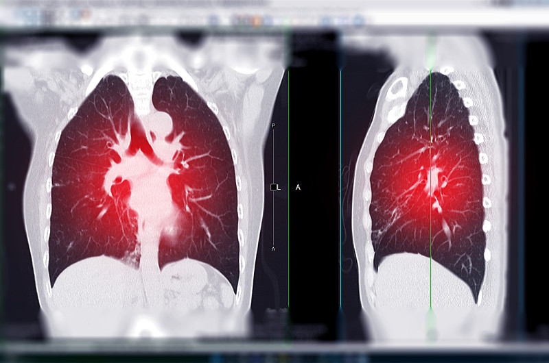 ct胸部或肺ct扫描冠状位和矢状位