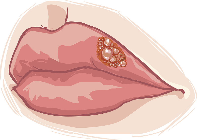 白色背景矢量插图的嘴唇疱疹