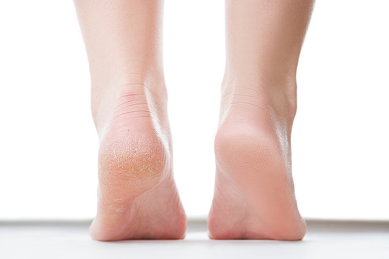 前后足部护理理念，女性足部，脚癣隔离在白色背景上
